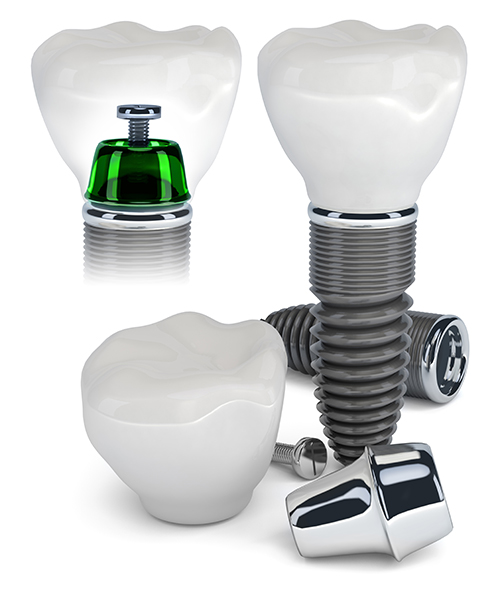 Dental Implants 46176