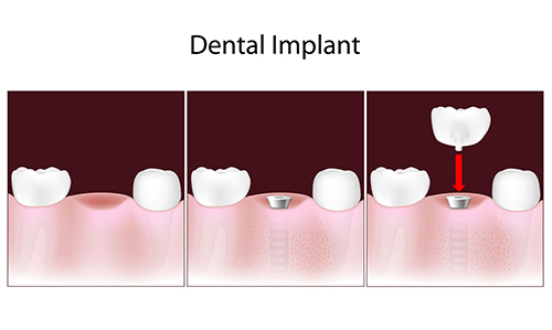 Shelbyville Dental Implants