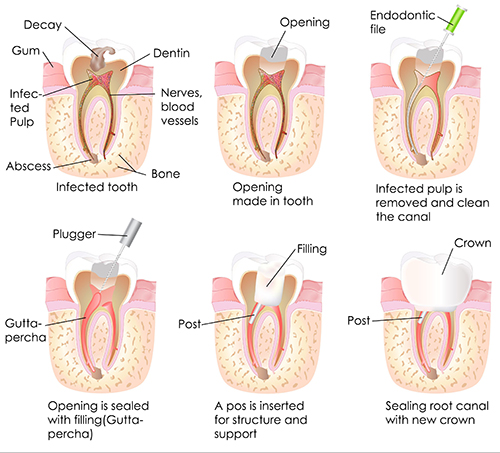 Root Canal Therapy in Shelbyville